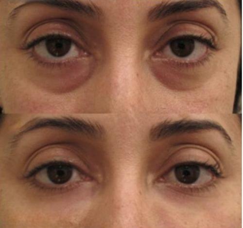 LumiEyes™ Under-Eye Red Light Therapy Goggles