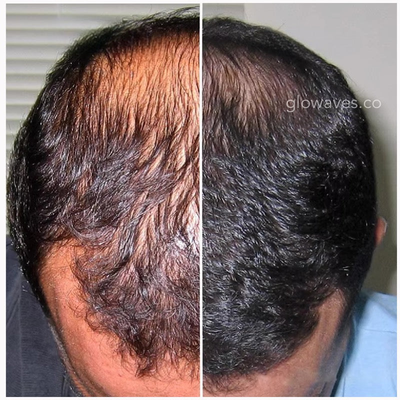 Infrared HairRegrowth Pro - GloWaves
